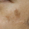 症例写真集②：ピコレーザー（ピコシュアプロ）治療例