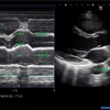 心エコーＭモード。大動脈弁レベル。