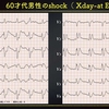 ECG-247：60才代男性。失神です、心電図を読んでる時じゃない！？