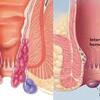 Cara menyembuhkan ambeien atau wasir