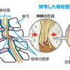 脊柱管狭窄症