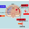 くも膜下出血
