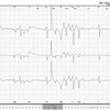 心電図に混入するノイズの話　その5 （VT/Vfと見紛う程のアーチファクトはどこから?）