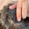 【円光】紫外線照射20回目