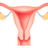 ACTUAL UTERINE FIBROIDS EMBOLIZATION