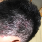 朝に体を洗うようにしてたら 頭皮ニキビが凄いことになっていて泣いた 頭皮ニキビ 治療 ある大学生の日常サンプル