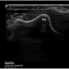 症例128：陰部の傷が治らない男性（Ann Emerg Med. 2021 Mar;77(3):e87-e88.）