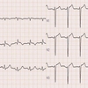 ECG-148：answer