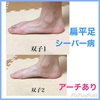 シーバー病⁉︎ そうじゃないよ。