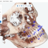 Dentbird StudioでCT解析とデータのマッチング！
