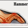 Natural Hammer Toe Treatment