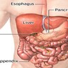 Cholecystitis