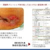 褥瘡を科学する