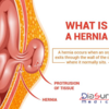 The Laparoscopic Surgery For Treating Inguinal Hernia