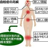 低用量ピルと血栓症