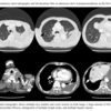 Angiosarcoma 血管肉腫と肺転移