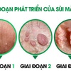 THUỐC CHỮA BỆNH SÙI MÀO GÀ Ở NAM GIỚI