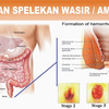 Cara Menghilangkan Ambeien Secara Permanen