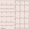 ECG-114：62才男性。昨夜からの胸部不快発作です。