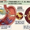 中医学的な見地でポリープを観れば？　痰と瘀血が絡み合う痰瘀互結が関係するって﻿