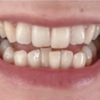 歯列矯正　１ヶ月🦷✨
