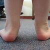 Flat Feet In Adults 