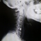 頚椎ヘルニア症状とアロマテラピー