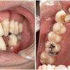 歯周病の治療と矯正
