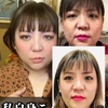たるみ解消若返り整形のトレンドと落とし穴