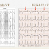 ECG-137：answer