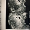 5週4日 胎嚢確認 双子