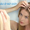 Cách chữa hói đầu ở nữ giới