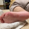 子どもの足の裏にやけどを負わせてしまった