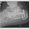 What Can Induce Inferior Calcaneal Spur