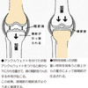 ★変形性膝関節症にアンクルウェイト（足首のおもり）が効く？！★