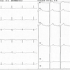 ECG-154：81才女性。労作時の胸部不快感での入院です。