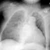ECG-115：74才女性。電撃性肺水腫で搬入される。