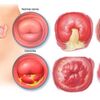 Hình ảnh viêm lộ tuyến cổ tử cung | Sức khỏe phụ khoa