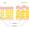 セルライトって何か分かりますか？？