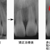 歯根吸収