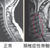 ミニレクチャー No. 94：頚椎症性脊髄症とは？