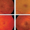 Age-Related Macular Degeneration Therapeutics Analysis, Clinical Trials and Developments