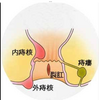 痔に手術は要らない。