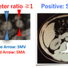 小ネタ：postobstructive diuresis, smaller SMV sign, 小児DKAの初期輸液は生食？