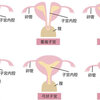 単角子宮って？（子宮奇形とその種類）