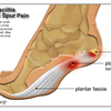 What Leads To Plantar Fasciitis