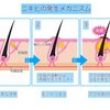 ニキビをなくしたかったら、ニキビを知れ！ニキビが出来るメカニズム！