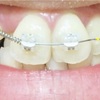 大人の歯列矯正 11 〜 前歯にも装置がつきました 〜