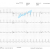 stress ecgとは何ですか?また、冠状動脈性心臓病の診断と治療を改善するために使用することができます!