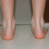 The Causes And Treatment Of Overpronation